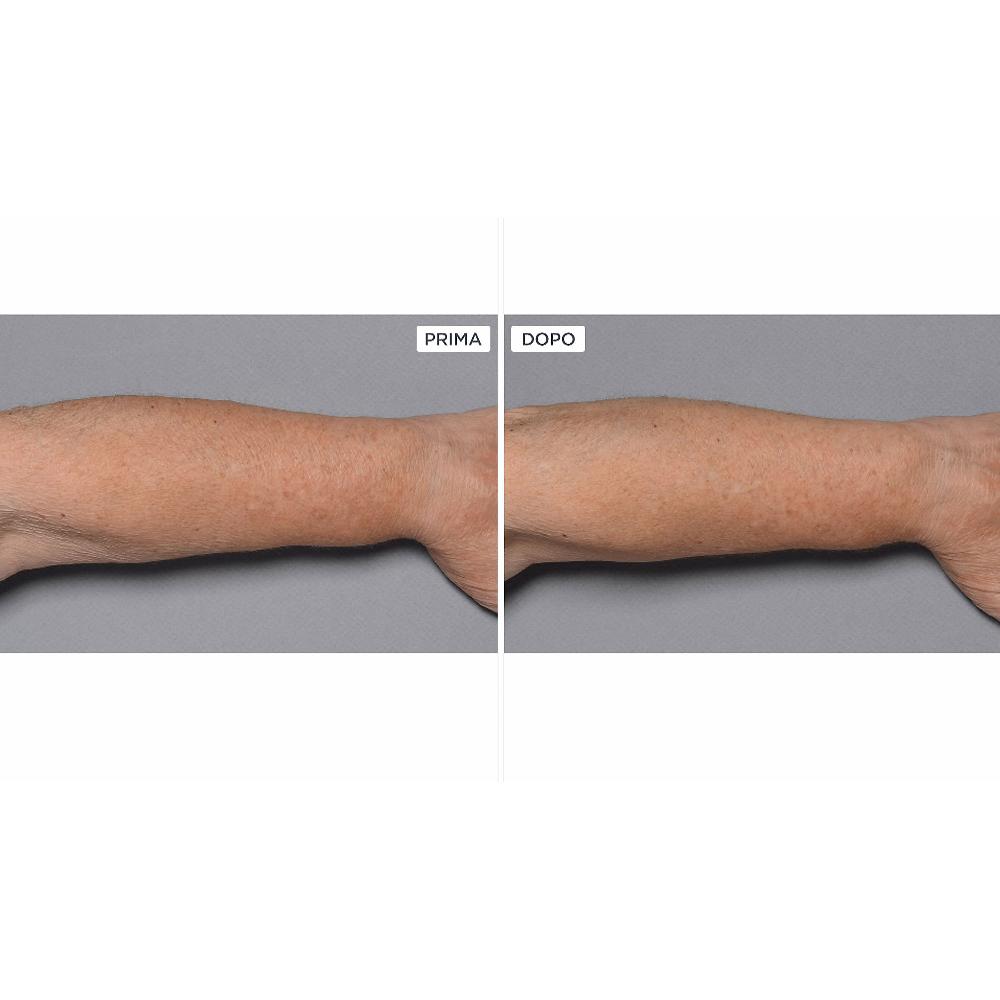 QVC Perricone MD Cold Plasma+Fragile Skin corpo 2pz Sostegno trimestrale