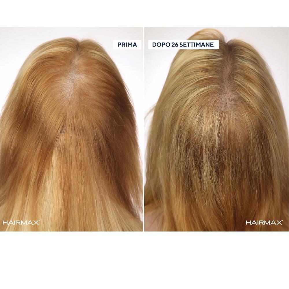 QVC HairMax LaserBand Dispositivo laser crescita capellI ACQUISTA ORA