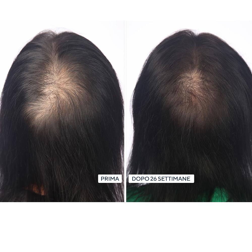QVC HairMax LaserBand Dispositivo laser crescita capellI ACQUISTA ORA